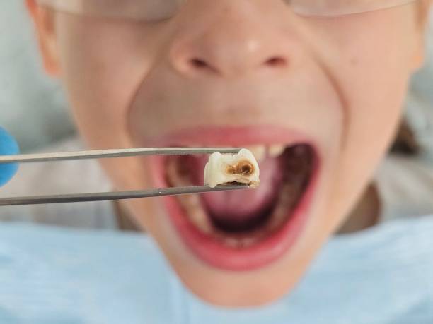 Best Knocked-Out Tooth (Avulsed Tooth) Treatment in Merrill, IA